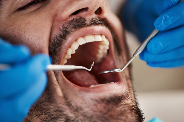 Best Chipped Tooth Repair Near Me  in Riverside, CA
